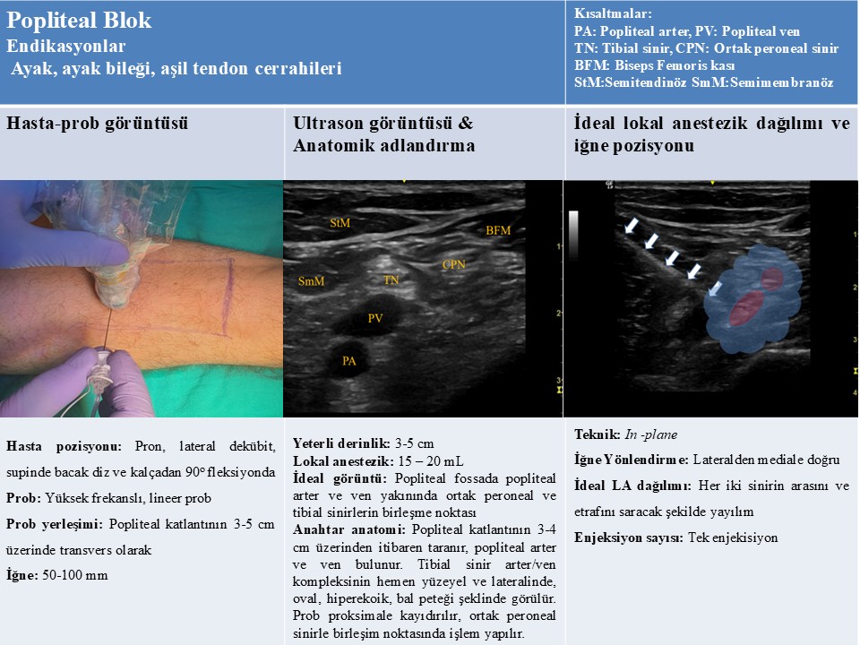 Popliteal Blok